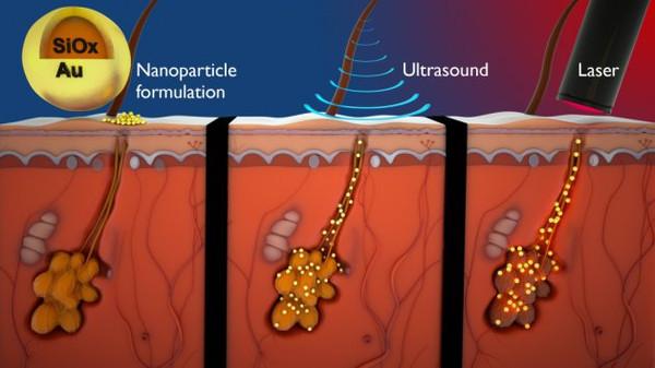 Nano parçacıkları ile akne tedavisi mümkün