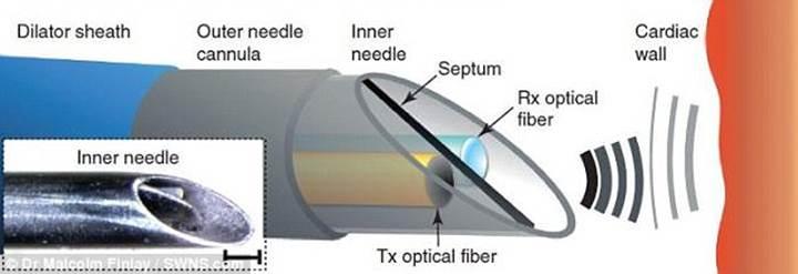 Yeni optik ultrason iğnesi minimal invazif cerrahide umut vadediyor