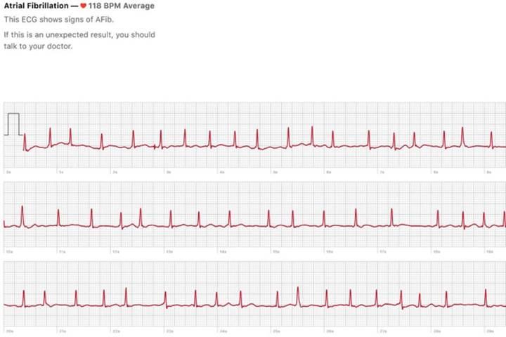 Apple Watch 4'ün EKG özelliği şimdiden hayat kurtardı