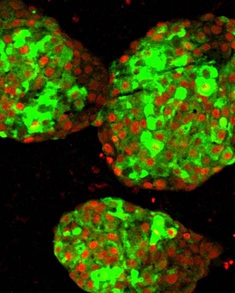 Tip 1 diyabet yeni kök hücre buluşu ile tarih olabilir