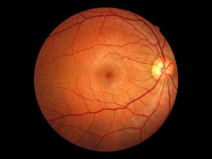 Akıllı telefon adaptörü ile diyabetik retinopati belirlenebilir