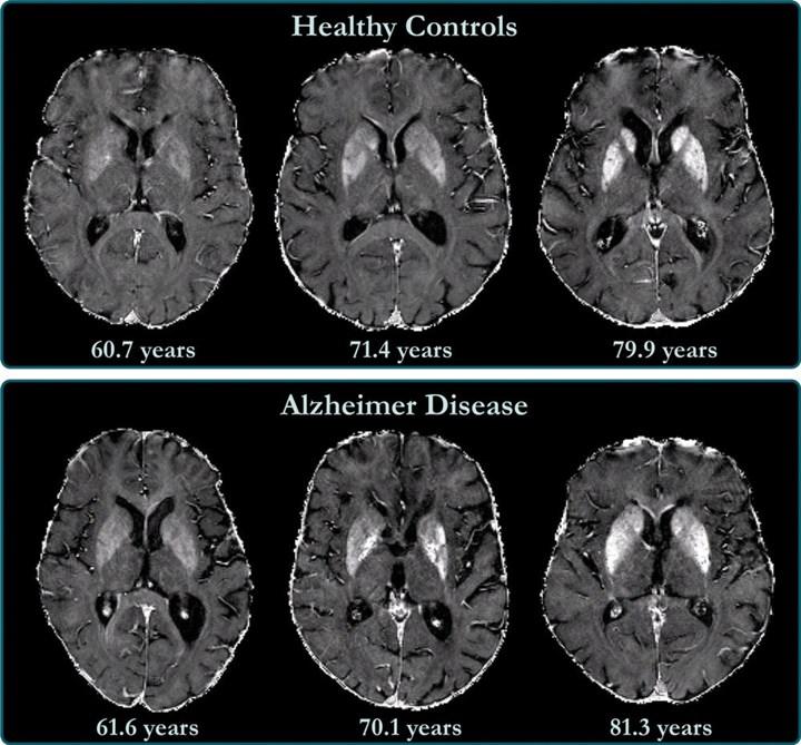 Alzheimer prognozu ile beyindeki demir birikimi arasında korelasyon tespit edildi