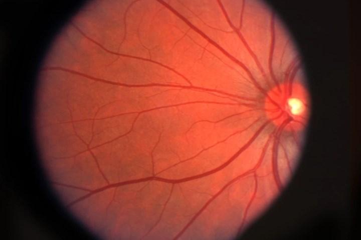 Yaşa bağlı makula dejenerasyonu için yapay retina geliştirildi