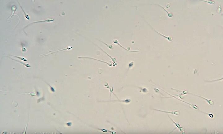 Spermde bulunan biyobelirteçler ile otizm riski belirlenebilir