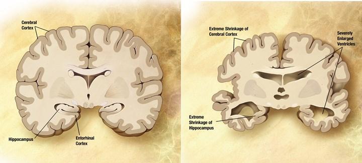 Amerika Birleşik Devletleri Alzheimer ilacını onayladı