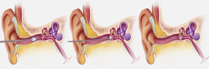 3D baskılı kulak zarı onarım yaması pazara hazır