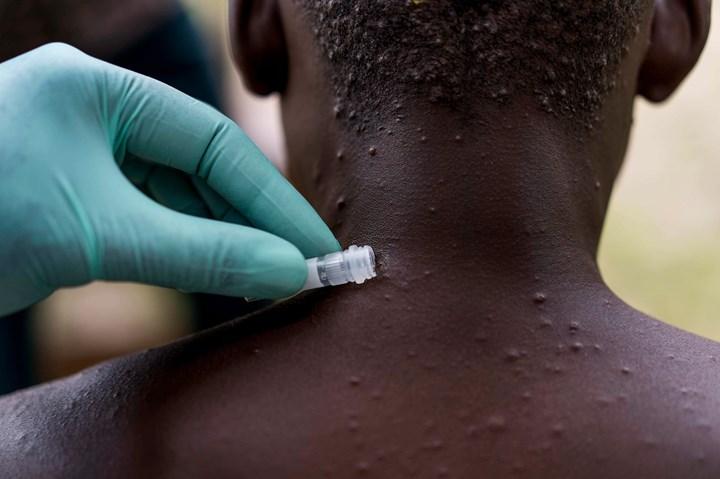 ABD'de maymun çiçeği aşısı kıtlığı yaşanıyor: Talep stoktan fazla
