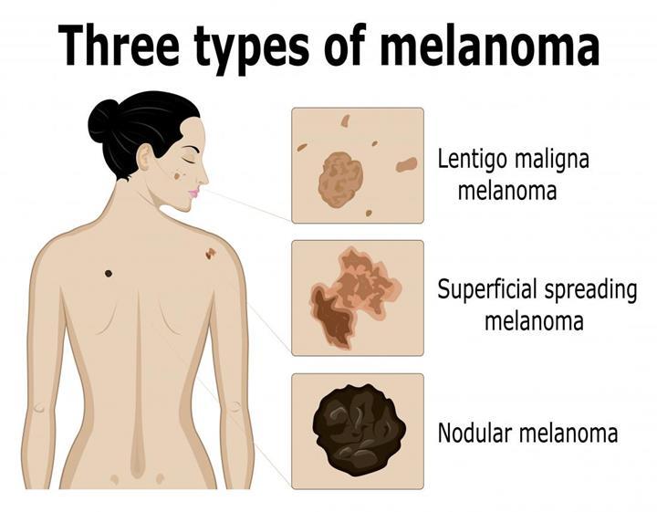 Malign melanom ile ilişkili yeni bir protein türü keşfedildi