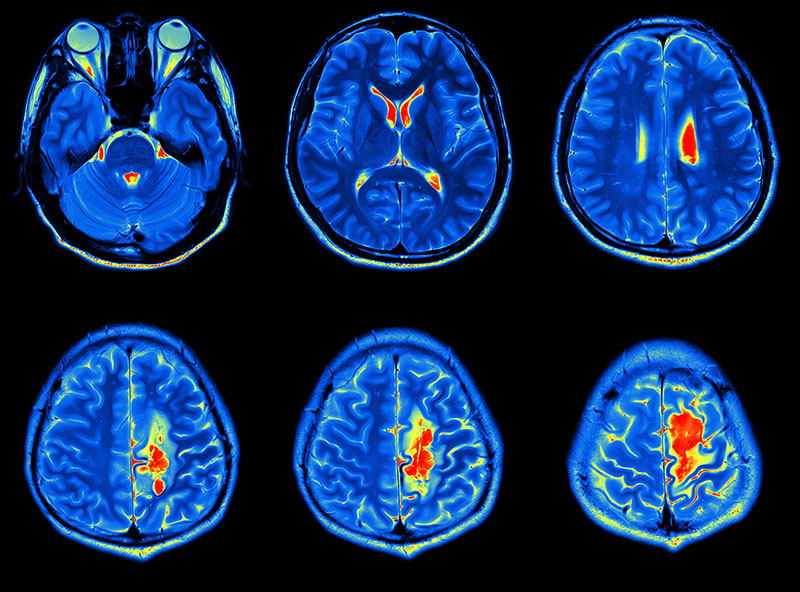 Bilgisayarlı tomografi beyin kanseri riskini arttırabilir