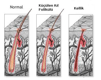 Saçları dökülmüş insanların kafası neden parlar?