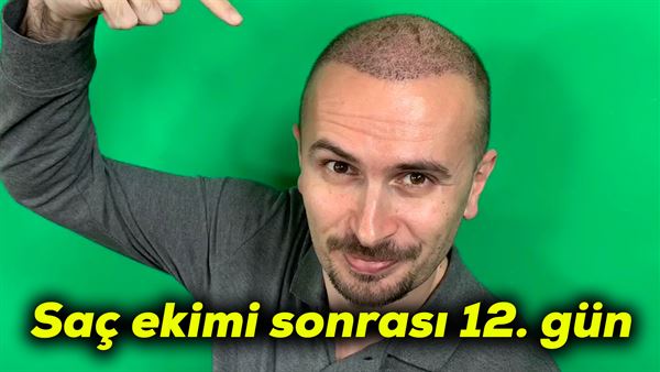 Sac Ekimi Sonrasi 12 Gun Ekilenler Uzuyor