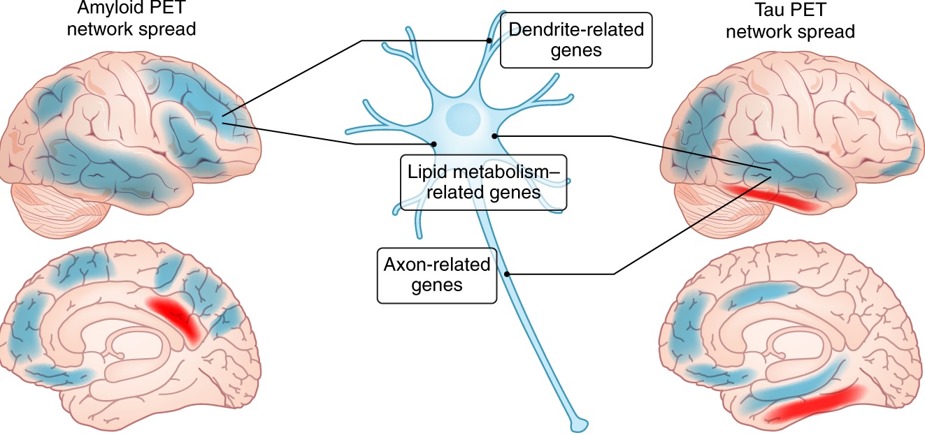 Alzheimer hastalığı iki aşamalı tanı yöntemi ile semptom göstermeden yıllar önce tespit edilebilecek