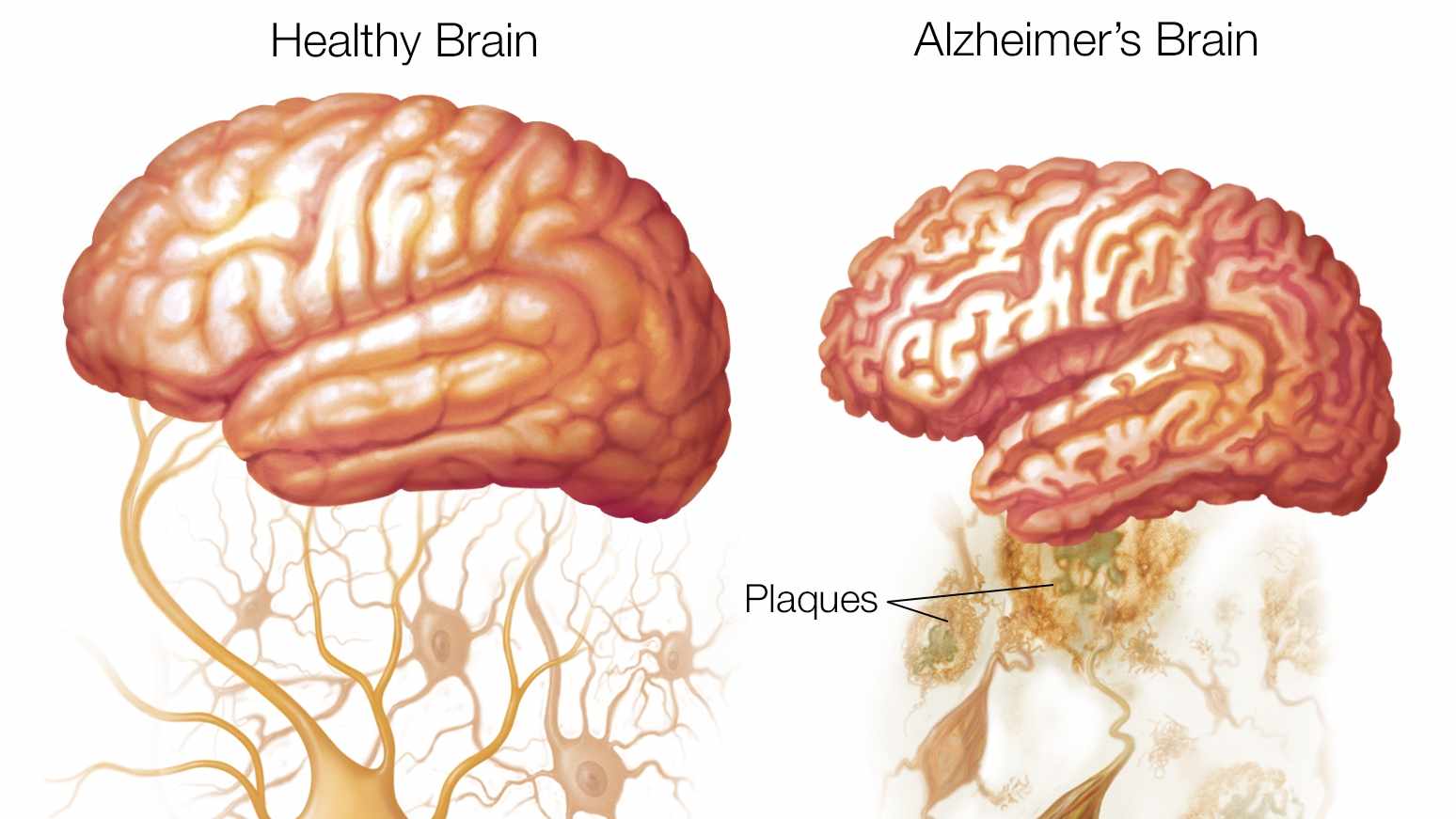 Alzheimer hastalığı iki aşamalı tanı yöntemi ile semptom göstermeden yıllar önce tespit edilebilecek