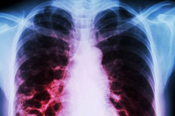 ‘Elektronik sigaraya bağlı’ solunum hastalığı nedeniyle bir kişi hayatını kaybetmiş olabilir