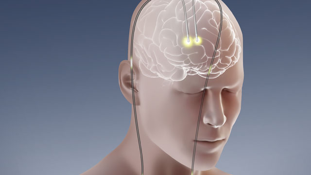 Beyne yerleştirilen elektrotlar, opiat bağımlılığını tedavide kullanılacak