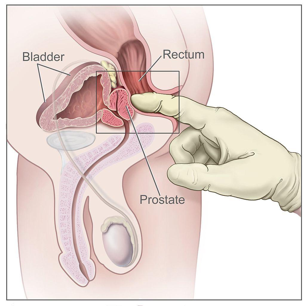 Yeni idrar testi ile prostat kanseri erken teşhis edilebilecek