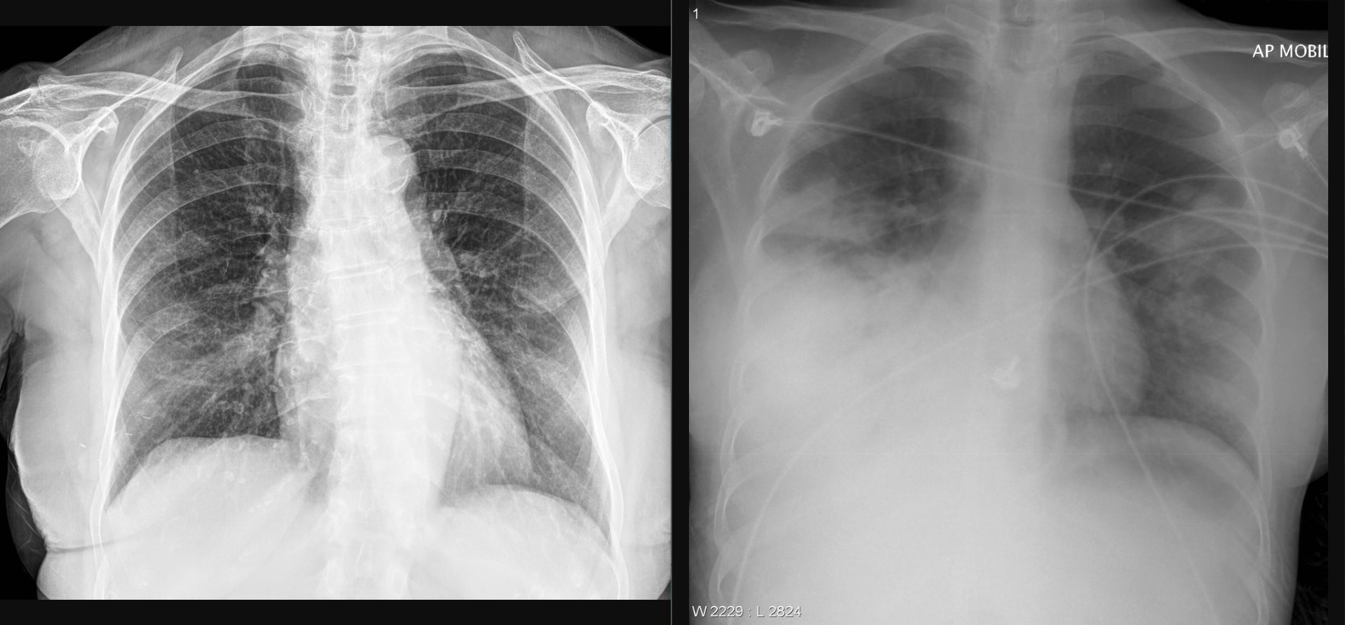 Türk araştırmacıdan röntgen görüntüsü ile Covid-19 pnömonisini belirleyen web sayfası
