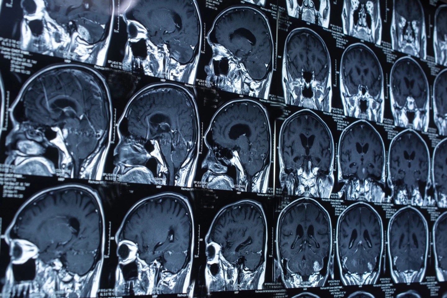 Yapay zeka beyin lezyonlarının tanısında kullanılabilir