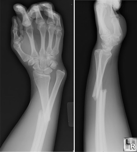 Yeni implant kemik onarımını hızlandırabilir