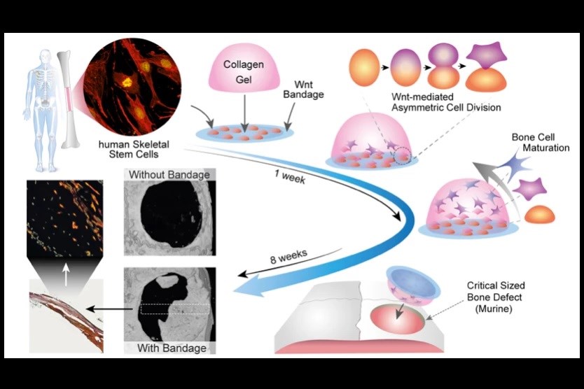 Kemik onarımına yardımcı olacak bandaj geliştirildi