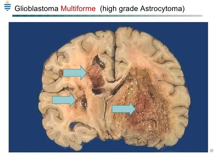 Glioblastoma multiformenin metastaz yolağını aydınlatabilecek cihaz geliştirildi