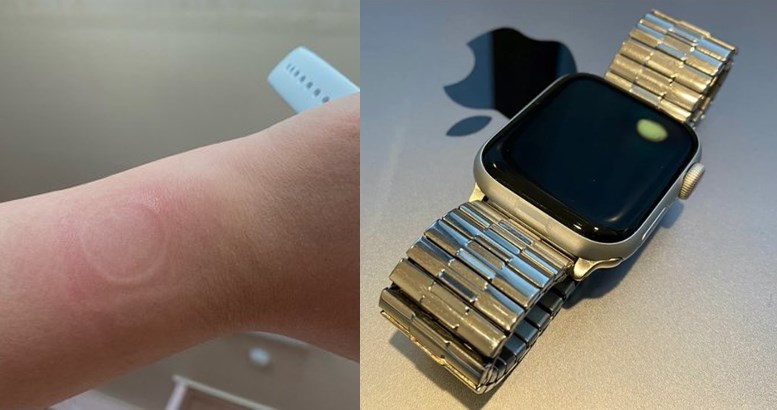 Apple Watch SE'de aşırı ısınma sorunu: Bileği yakıyor, ekranda leke oluşuyor
