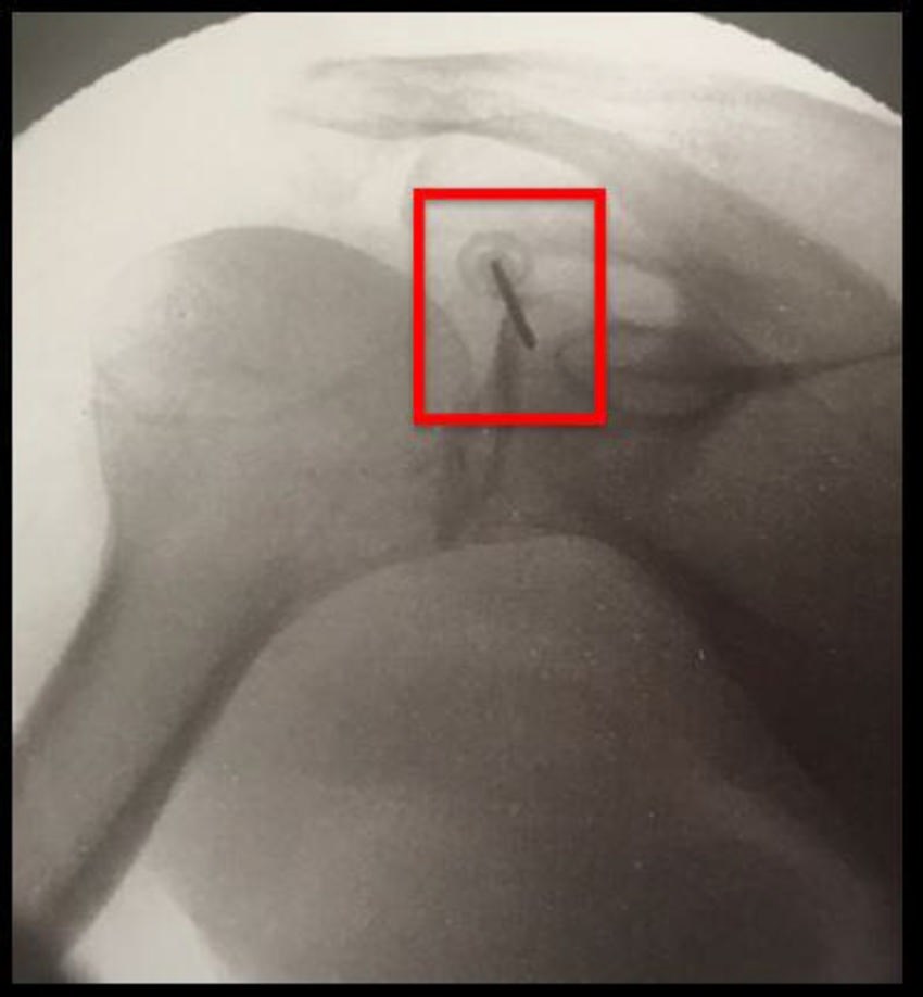 Radyofrekans ablasyon osteoartrit tedavisinde kullanılabilir