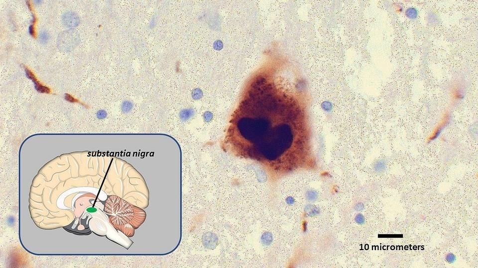 Parkinson'da hatalı katlanmış protein yayılımını azaltabilecek yapay enzim üretildi