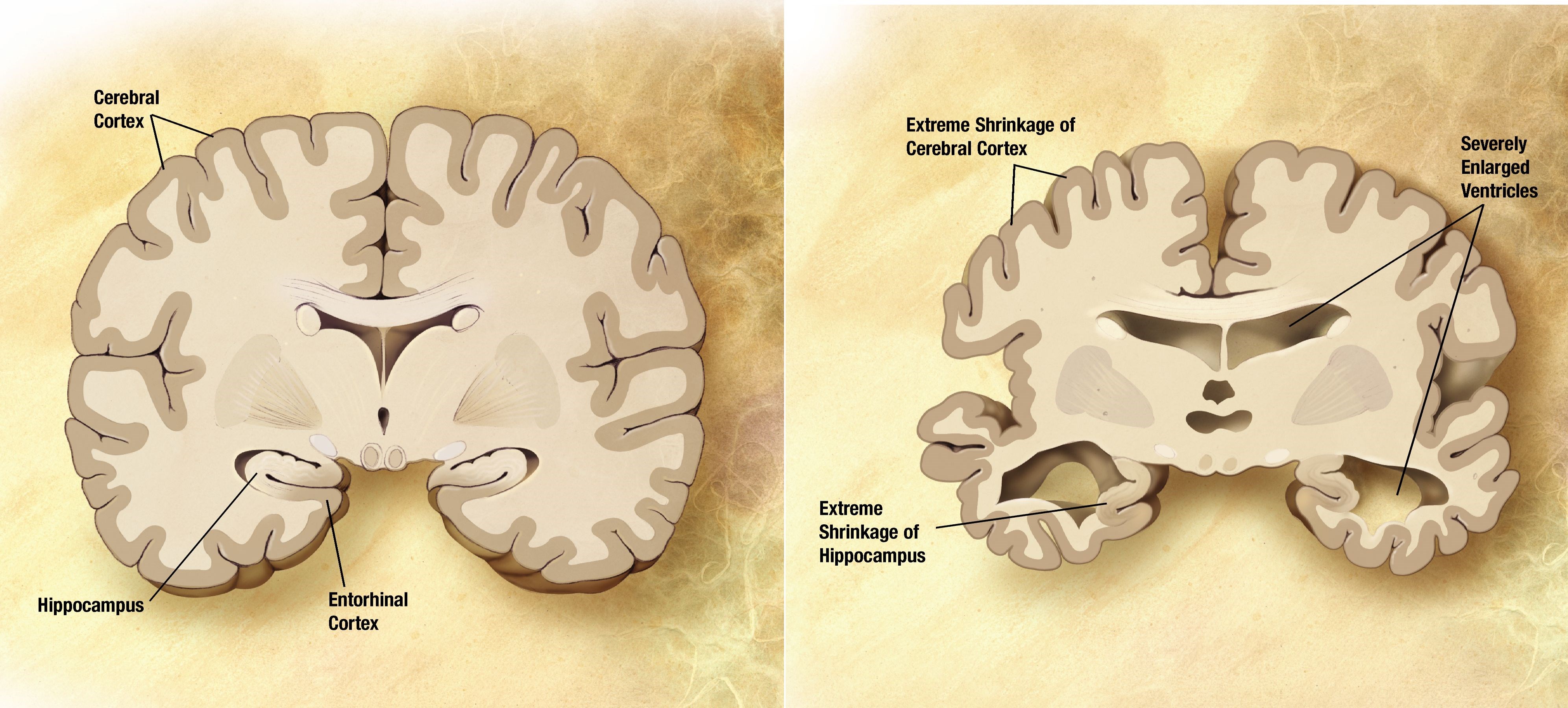 Alzheimer tedavisinde umut vadeden ilacın Faz 2 sonuçları yayımlandı