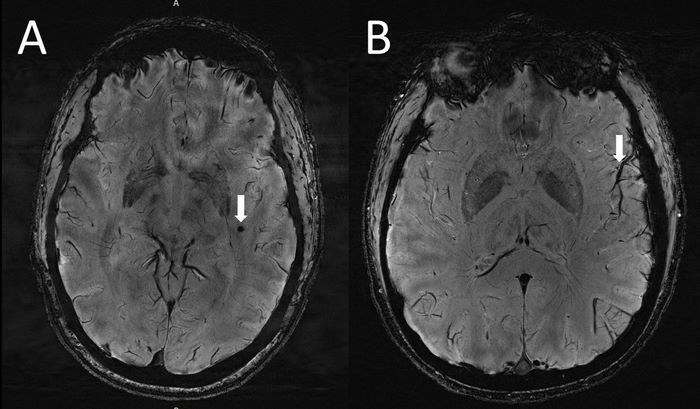 MRG, migren hastalarının beyinlerindeki boşlukları ortaya koydu