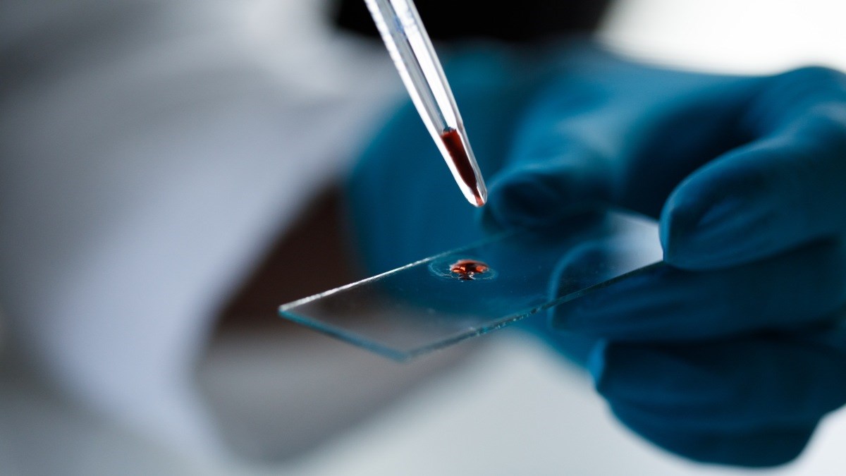 Geliştirilen yeni cihaz kan örneğinden kanseri tespit edebiliyor