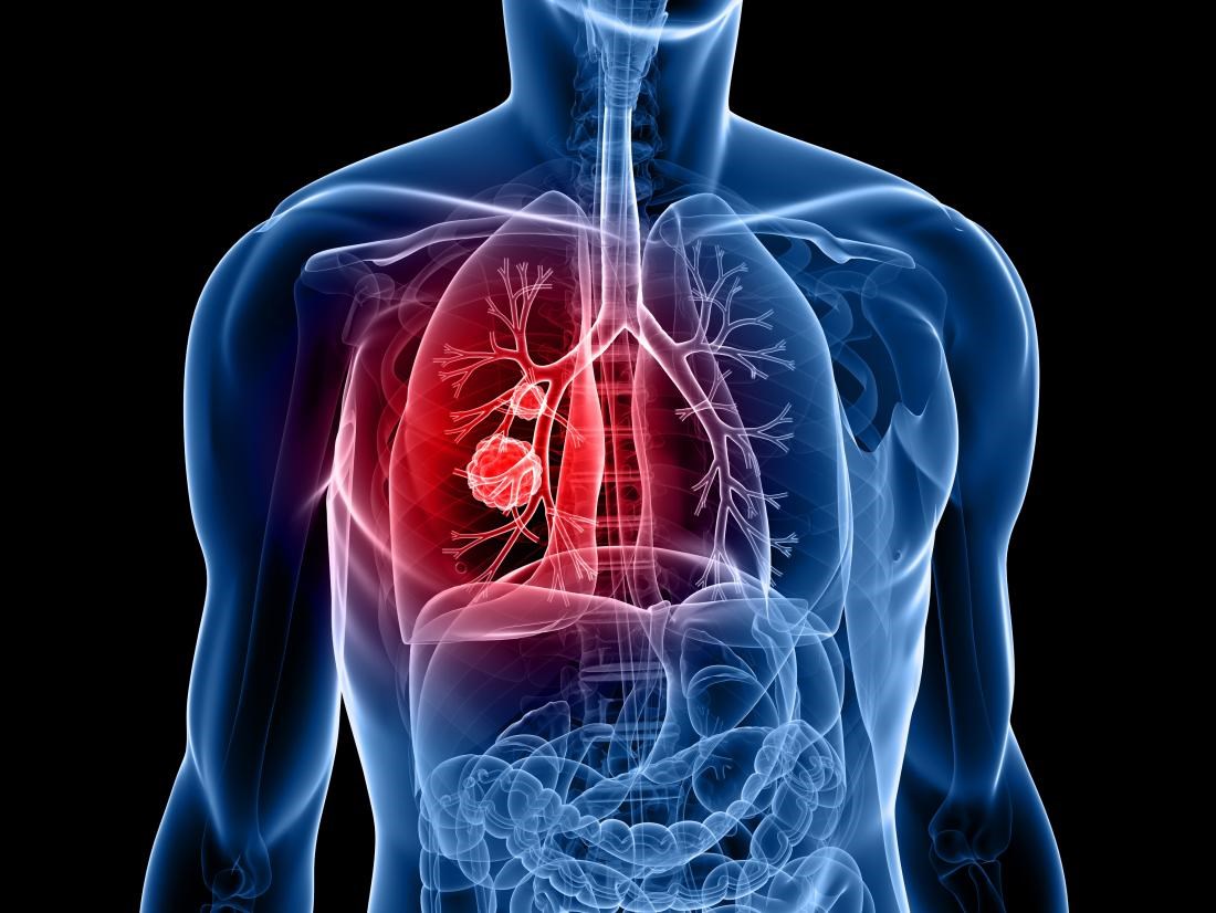 Yeni akciğer kanseri ilacı ölüm riskini yarı yarıya azaltıyor