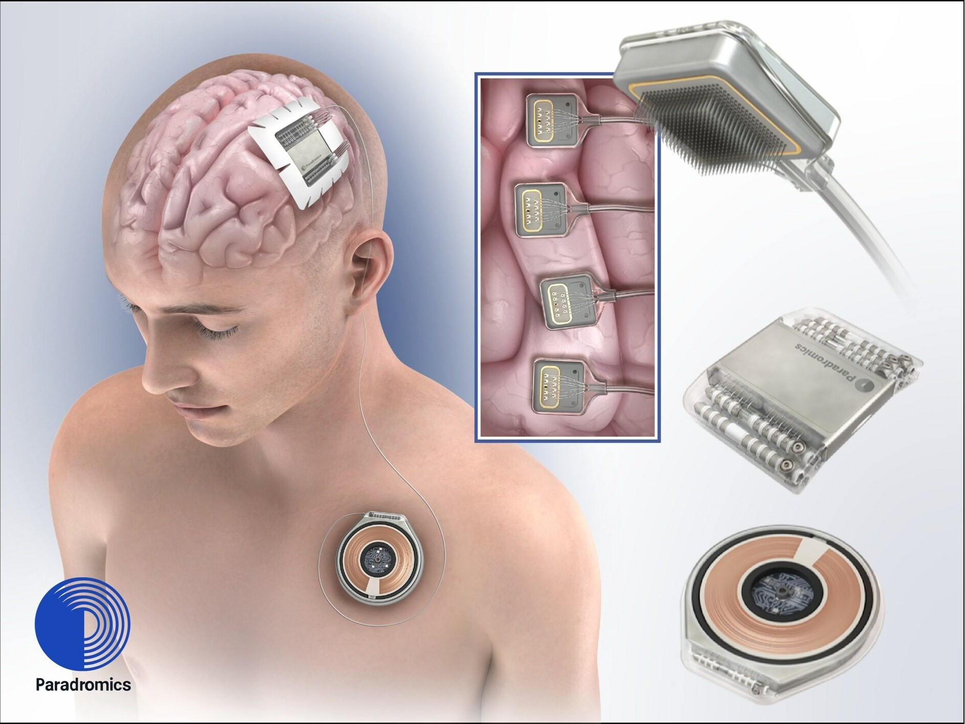 Neuralink rakibi Paradromics, ilk insan denemesin tamamladı