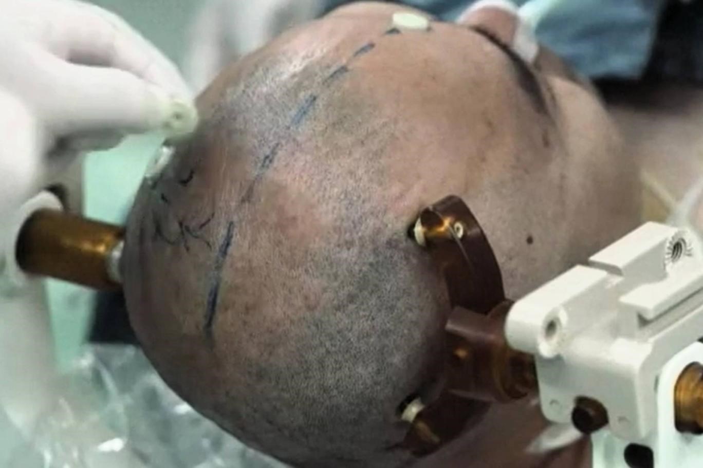 Çin, ilk beyin çipi ile klinik denemeler başladı