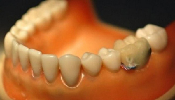 Ulusal Tayvan Üniversitesi, kötü alışkanlıkları takip için diş üzerine takılabilen sensör geliştirdi