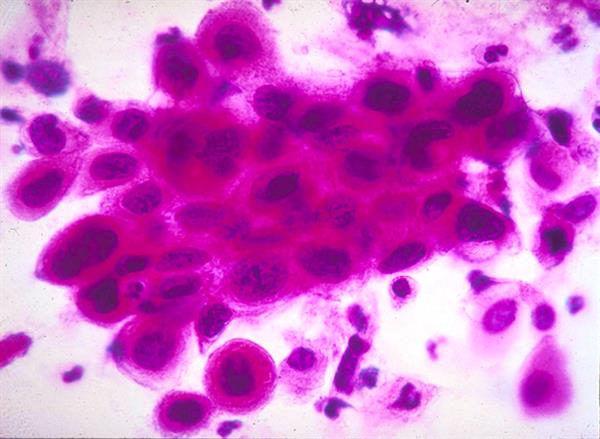 Kanserli hücrelerle savaş için 'nano-terminatör' devri