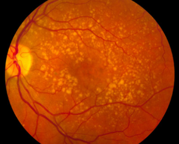 Yeni nesil retinal implant görme engelini ortadan kaldırabilir