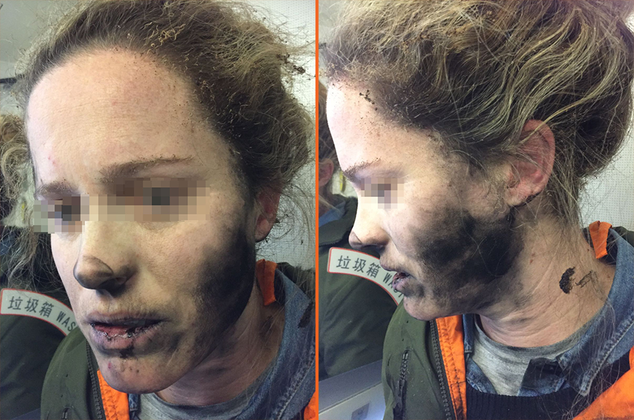 Kablosuz kulaklık patladı: Kullanıcının yüzünde yanıklar oluştu