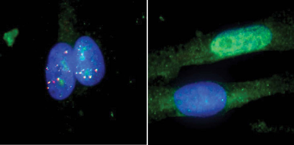 RNA düzenlemesiyle ALS tedavisi mümkün